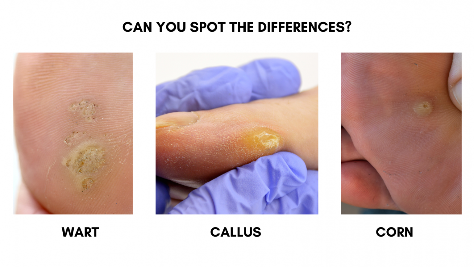 Corn Vs. Callus Vs. Wart - Darwin Podiatry