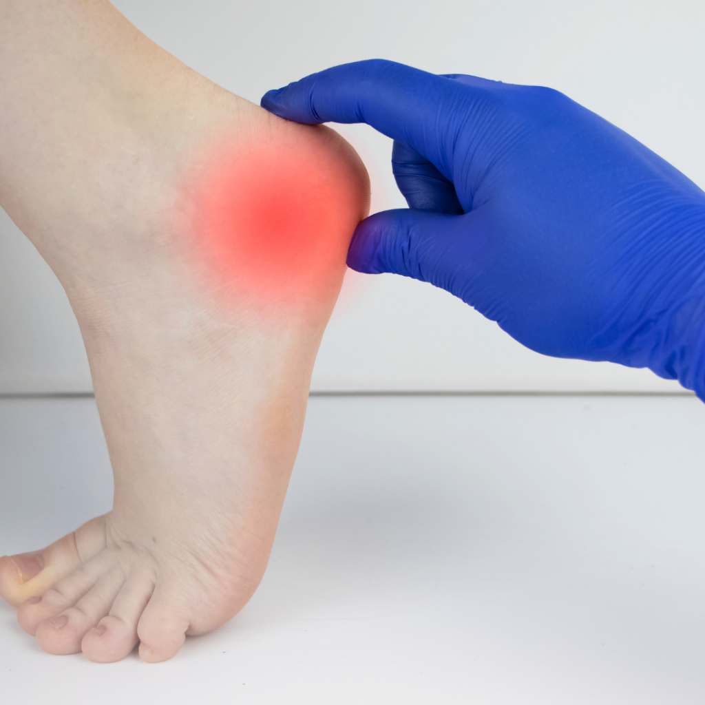 Heel Bursitis Darwin Podiatry